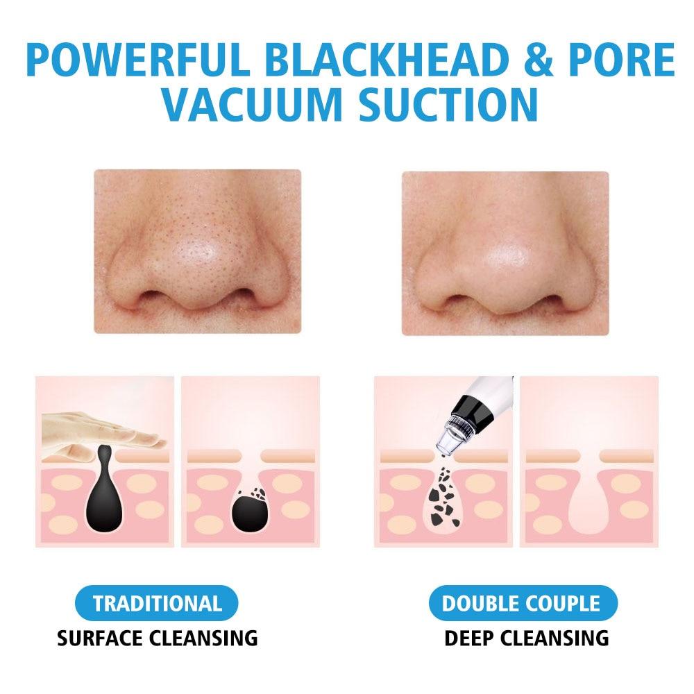 Blackhead Pore Vacuum for Brighter & Healthier Skin